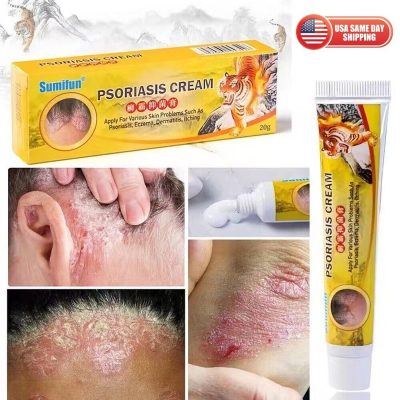 Health Care Psoriasis Cream Eczema Ointment Scalp Psoriasis Hand Tinea Foot 癣霸